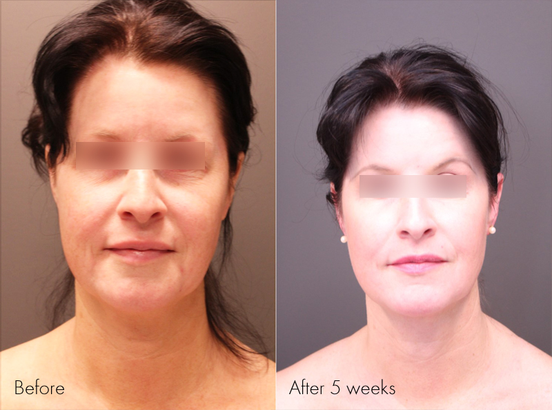 Pre Treatment, 5 weeks post Renuvion of the Neck and Profound with of the Face