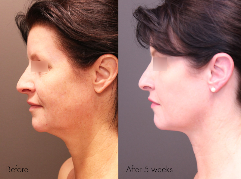 Pre Treatment, 5 weeks post Renuvion of the Neck and Profound with of the Face