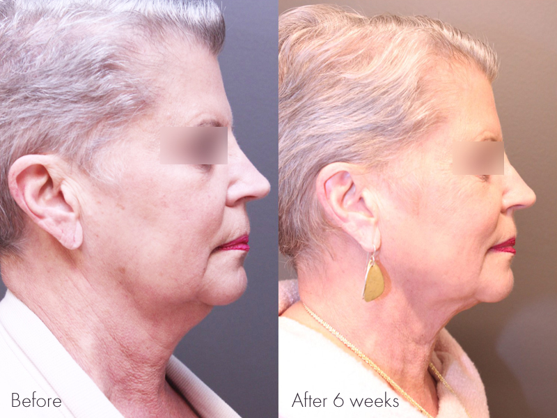 Pre Treatment, 6 weeks post Renuvion of the Neck with Liposuction for the jowls and Profound with PRP of the Face