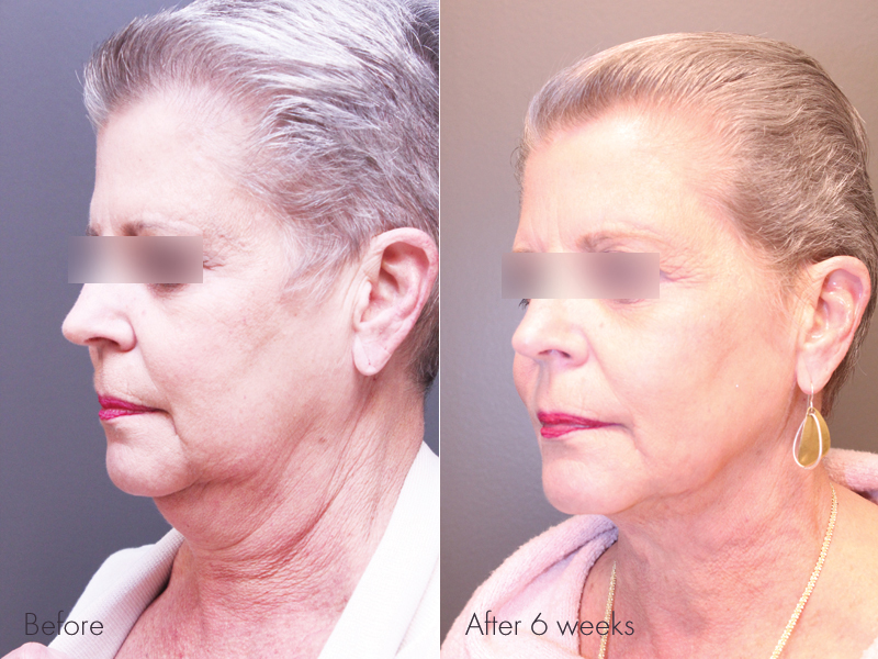 Pre Treatment, 6 weeks post Renuvion of the Neck with Liposuction for the jowls and Profound with PRP of the Face