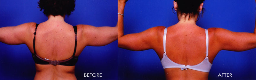 liposuction of the arms before and after procedure