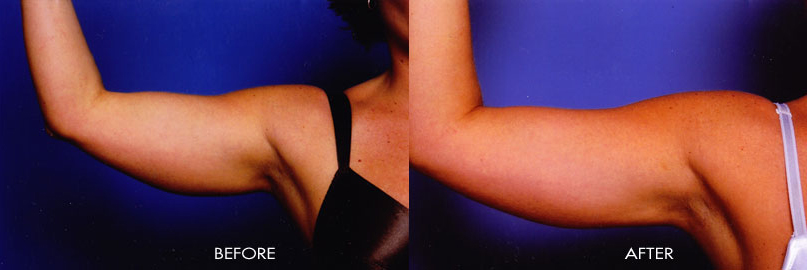liposuction of the arms before and after procedure