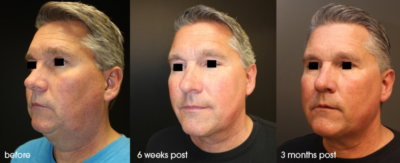 Renuvion skin tightening before, 6 weeks after and 3 months post procedure