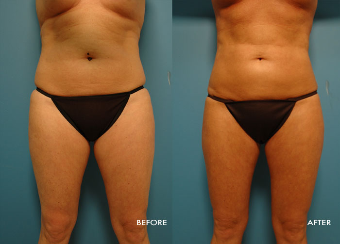 Womans torso before and after Vaser Shape procedure