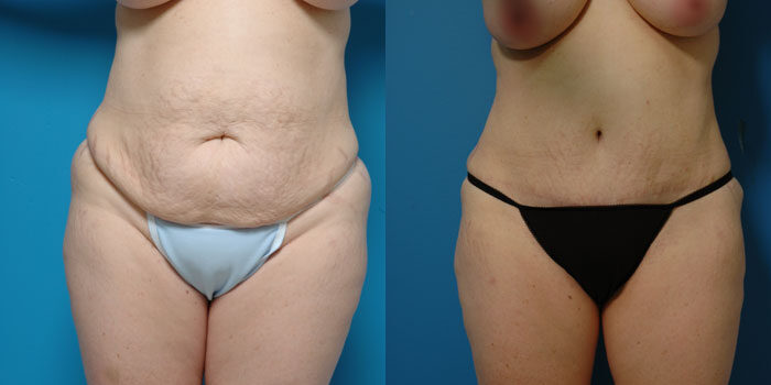 before Abdominoplasty and post surgery results