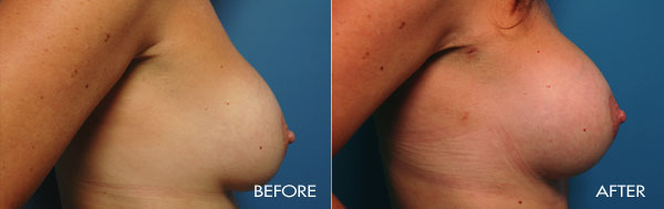 breast revision