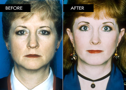52 year old - Facelift, Blepharoplasty, Brow Lift, Rhinoplasty, Chin Implant, Deep Laser Resurfacing