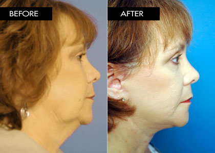 55 year old - Facelift Only