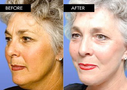 56 year old - Facelift