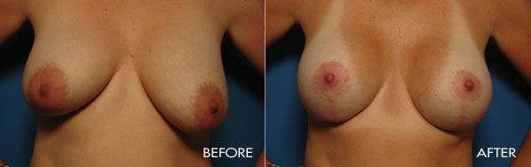 Revision Breast Procedures