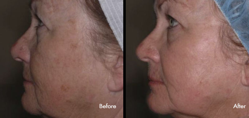 Before and after results of deep laser resurfacing of the face