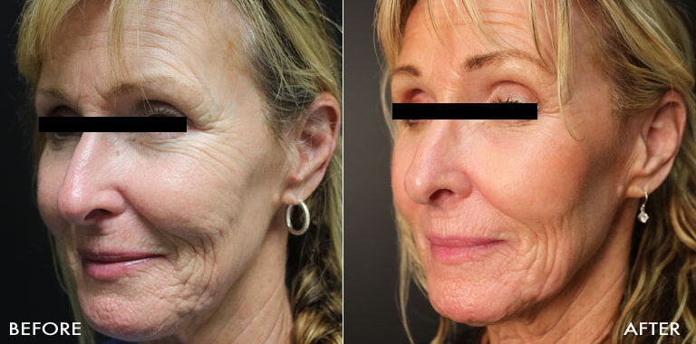 Before and after results of deep laser resurfacing of the face