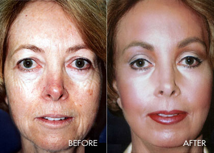 Before and after results of deep laser resurfacing of the face - 120 micron resurfacing. After 4 weeks.