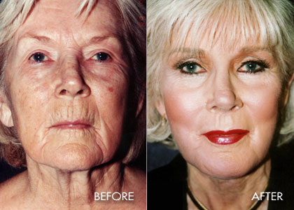 Before and after results of deep laser resurfacing of the face - 120 micron resurfacing.