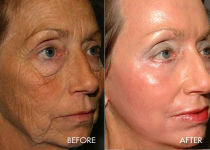 Sciton Full face Resurfacing and lower lid blepharoplasty.