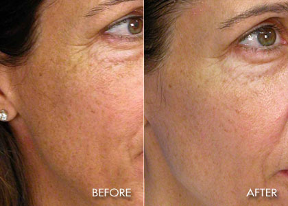 10 Micron Micro Laser Peel After 4 Treatments