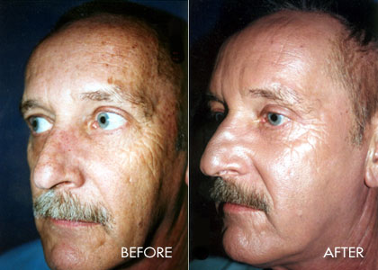 20 Micron Laser Peel After 2 Treatments