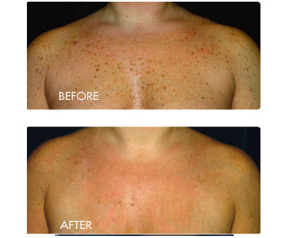 before and after image of bbl treatment on chest