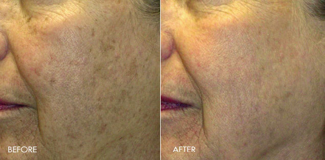before and after image of bbl treatment on face