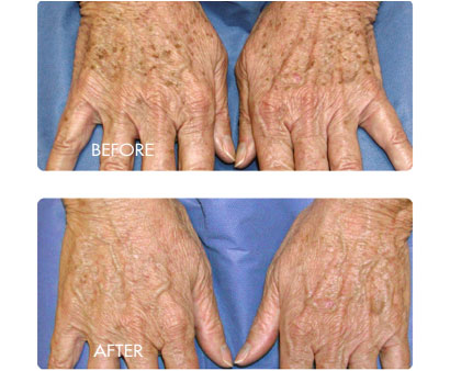 before and after image of bbl treatment on hand