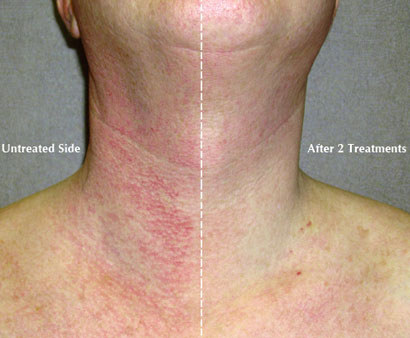 before and after image of bbl treatment on neck