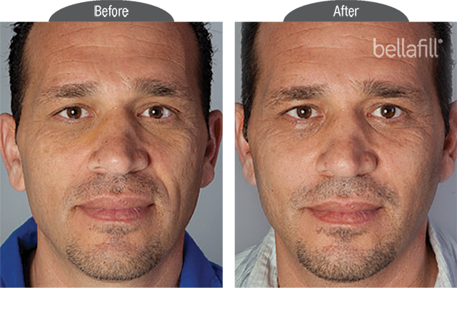 before and after results of bellafill used on face