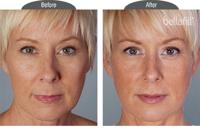 before and after results of bellafill used on face