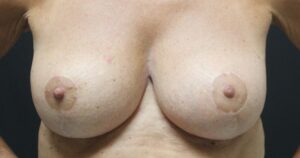 1 Year After Breast lift results