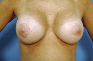 Breast Lift with implants