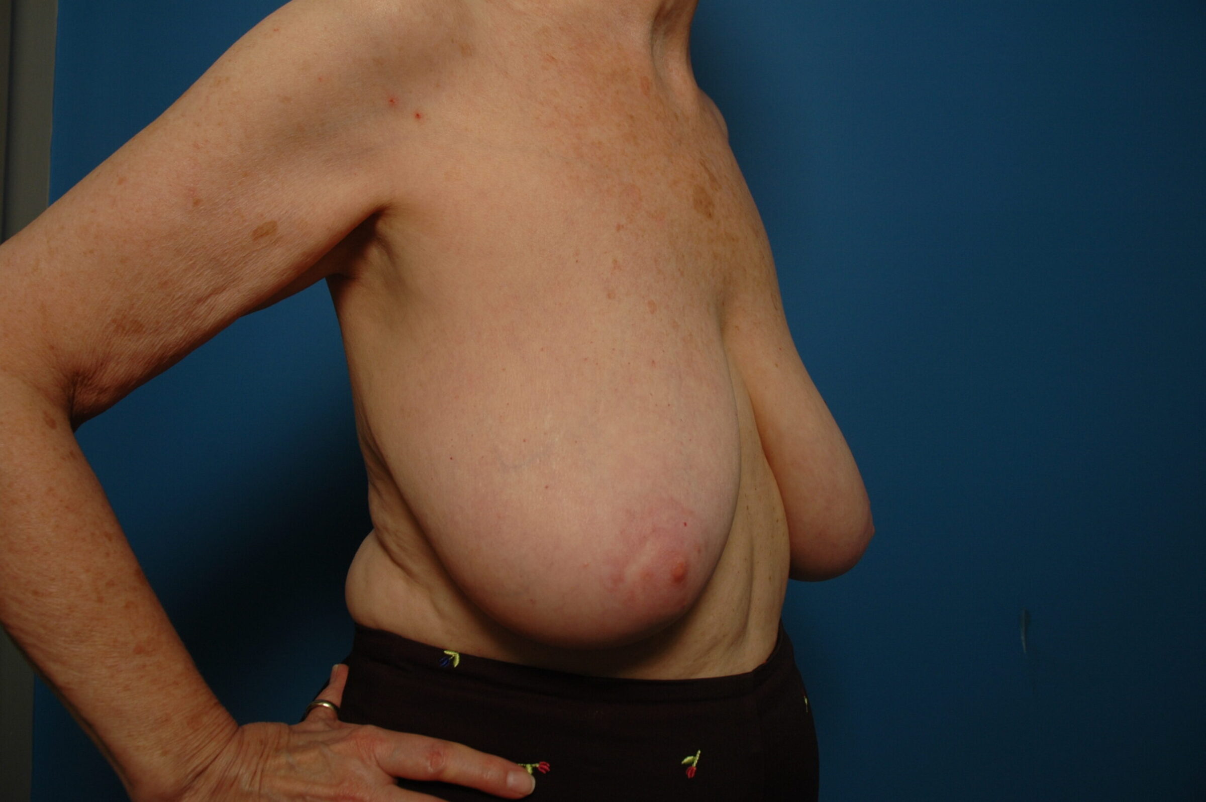 Breast Reduction - Before