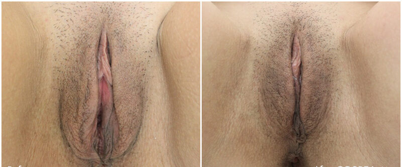 before and after images of vaginal rejuvenation