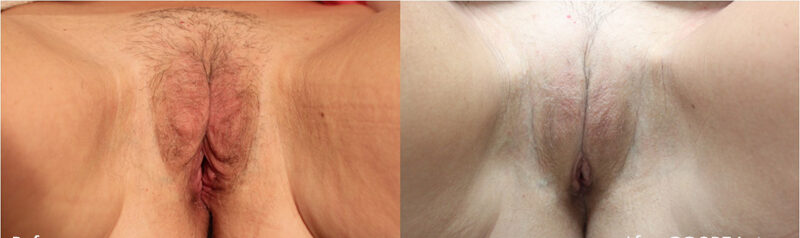 before and after images of vaginal rejuvenation