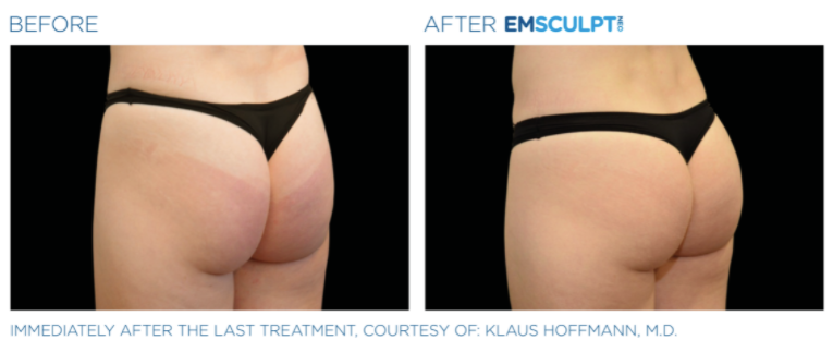 Before & after Emscuplt Neo Treatments on buttocks