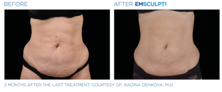 Before & after Emscuplt Neo Treatments on abdomen