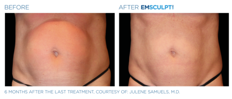 Before & after Emscuplt Neo Treatments on abdomen