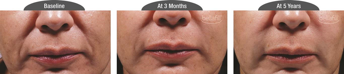 before and after results of bellafill used on nasolabial folds