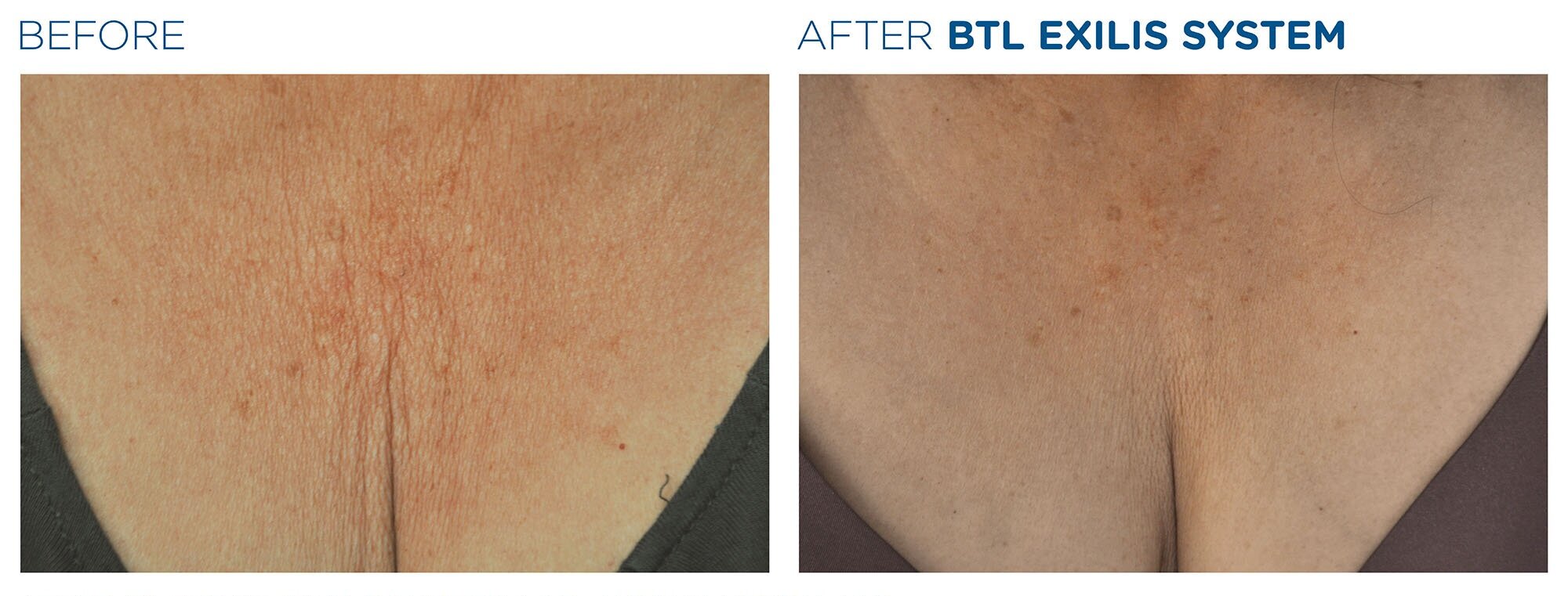Before EXILIS | After EXILIS Skin Tightening Treatment on Chest