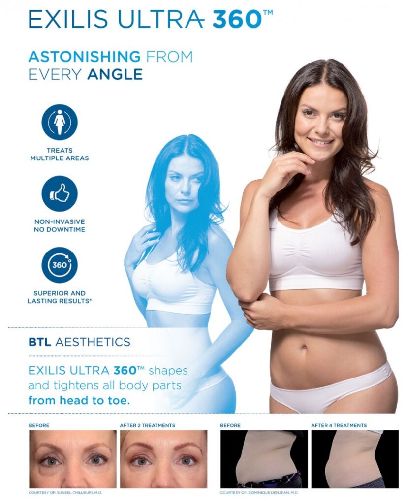 Exilis Ultra Infographic