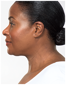 Kybella-Patient 1 - After