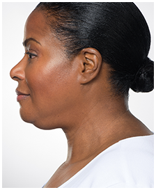 Kybella-Patient 1 - Before