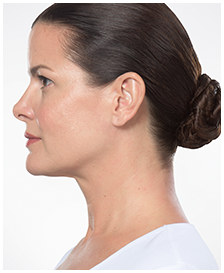 Kybella-Patient 2 - After
