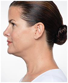 Kybella-Patient 2 - Before