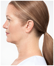 Kybella-Patient 3 - After