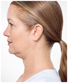 Kybella-Patient 3 - Before