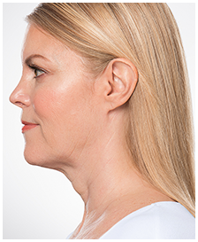 Kybella-Patient 4 - After