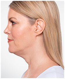 Kybella-Patient 4 - Before