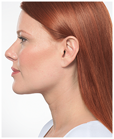 Kybella-Patient 5 - After