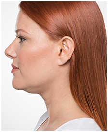 Kybella-Patient 5 - Before
