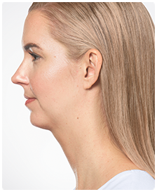 Kybella-Patient 6 - After
