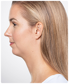 Kybella-Patient 6 - Before